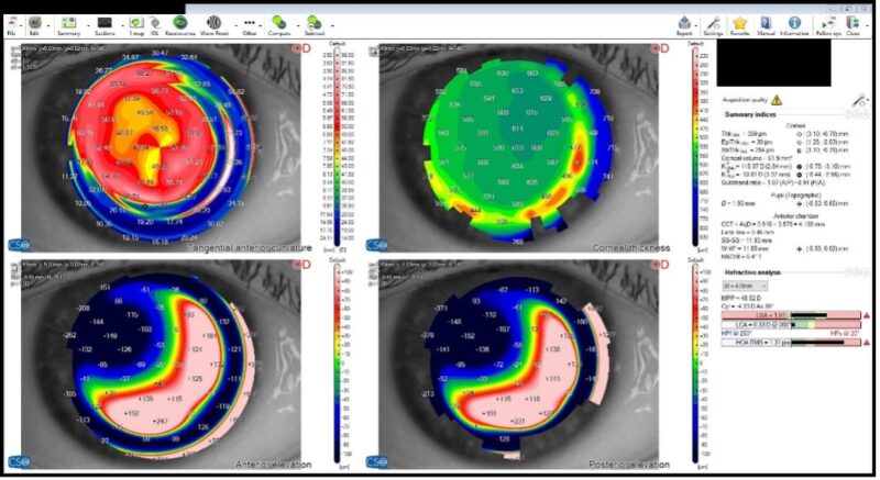 Managing Bilateral Penetrating Keratoplasty-Related Rim Ectasia and ...